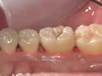術後の歯茎の位置