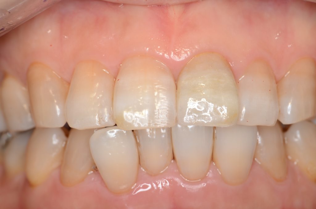 前歯治療　ジルコニアセラミック　テトラサイクリン歯