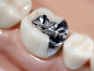 保険治療　インレー　虫歯