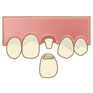 前歯の被せ物　差し歯　セラミック