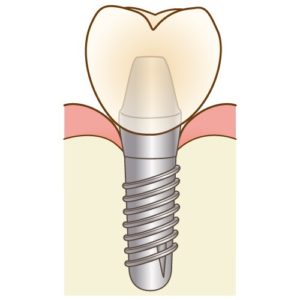 歯のインプラント　抜歯　インプラント価格