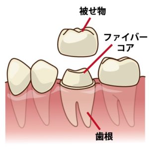 セラミックスの被せ物　神経のない歯　奥歯
