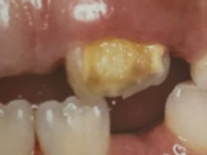 黄色い歯　エナメル質形成不全　歯科治療