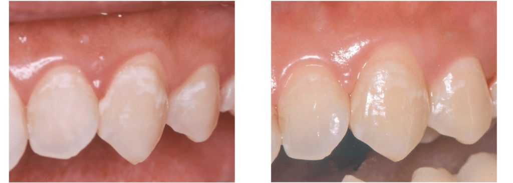 歯の再石灰化　脱灰　白濁した歯