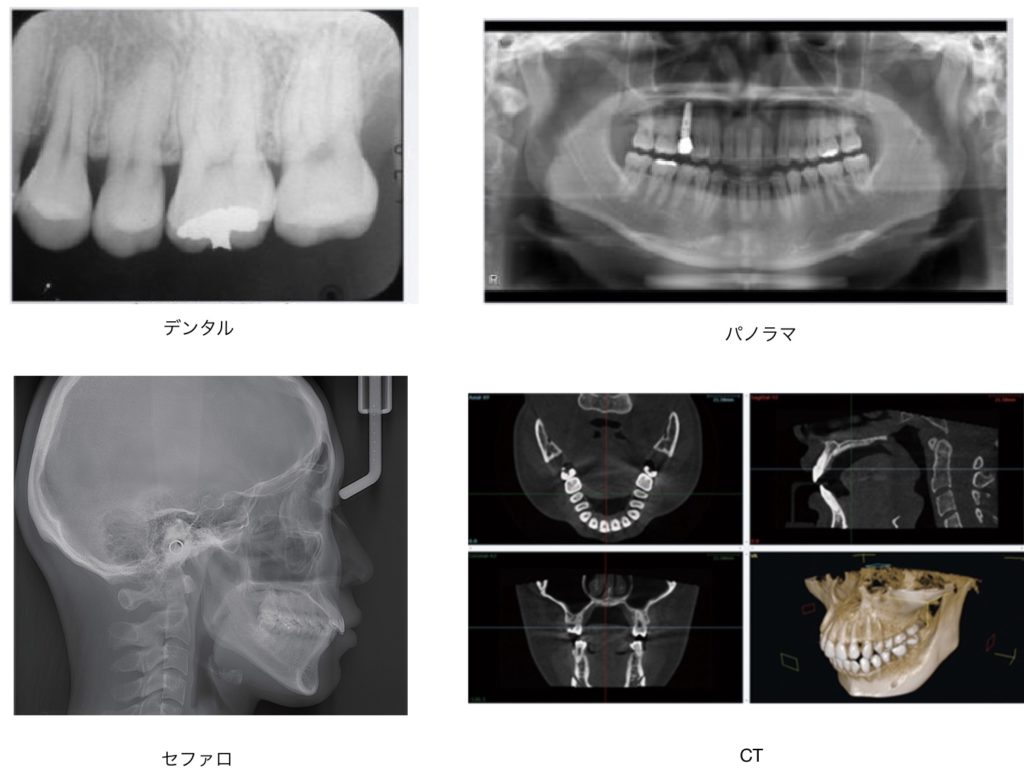 歯科でのレントゲン　歯科用CT 　パノラマ撮影