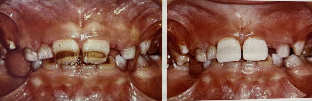 エナメル質形成不全症　治療　茶色い前歯
