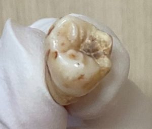 虫歯　歯科治療　歯の治療
