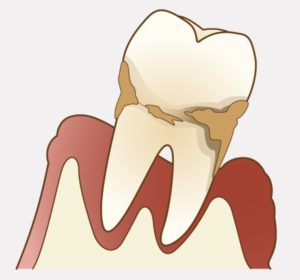 歯周病　歯と歯茎　歯と骨