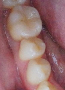虫歯治療　銀歯白く　保険治療