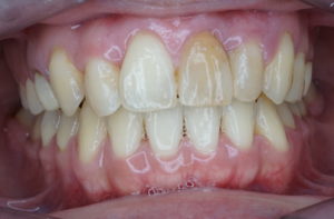 前歯治療　神経のない歯　変色した歯