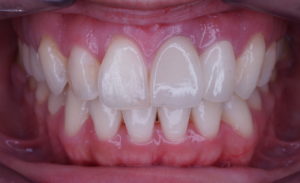 セラミック　自費治療　白い歯
