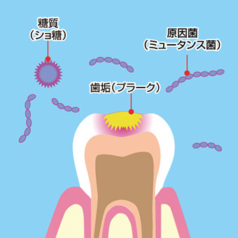 歯垢　原因菌　糖質
