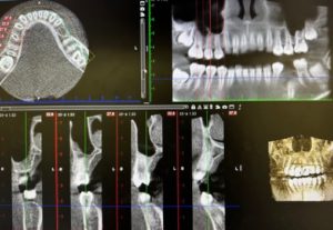 歯科用CT　断層撮影　矯正診断