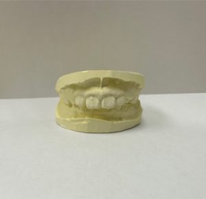 歯の模型　型取り　石膏模型