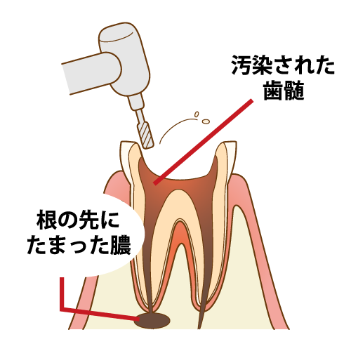 歯の根っこの治療　根管治療　登戸グリーン歯科・矯正歯科