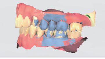 トリオス　インプラント　歯科デジタルデータ
