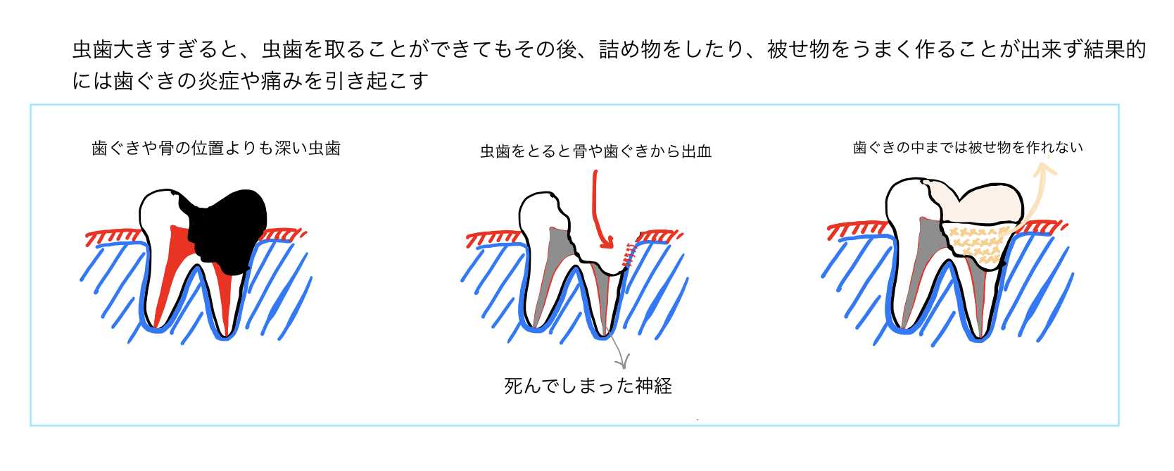 大きな虫歯　痛くない虫歯　虫歯の放置