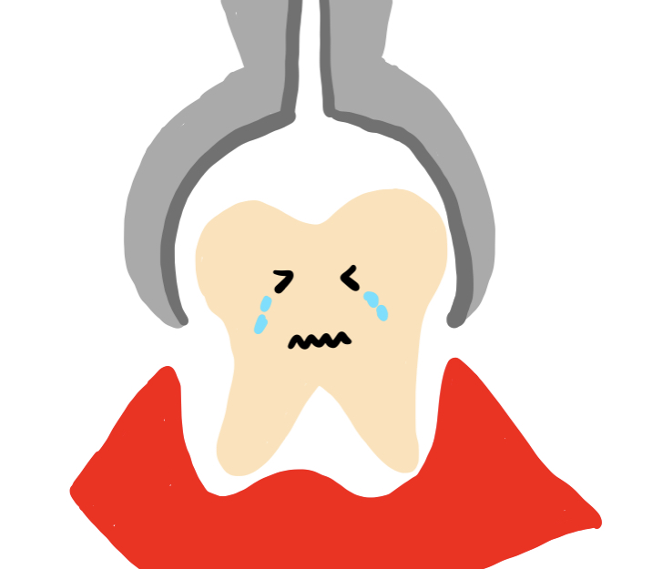 抜歯　歯を抜く理由　虫歯による抜歯