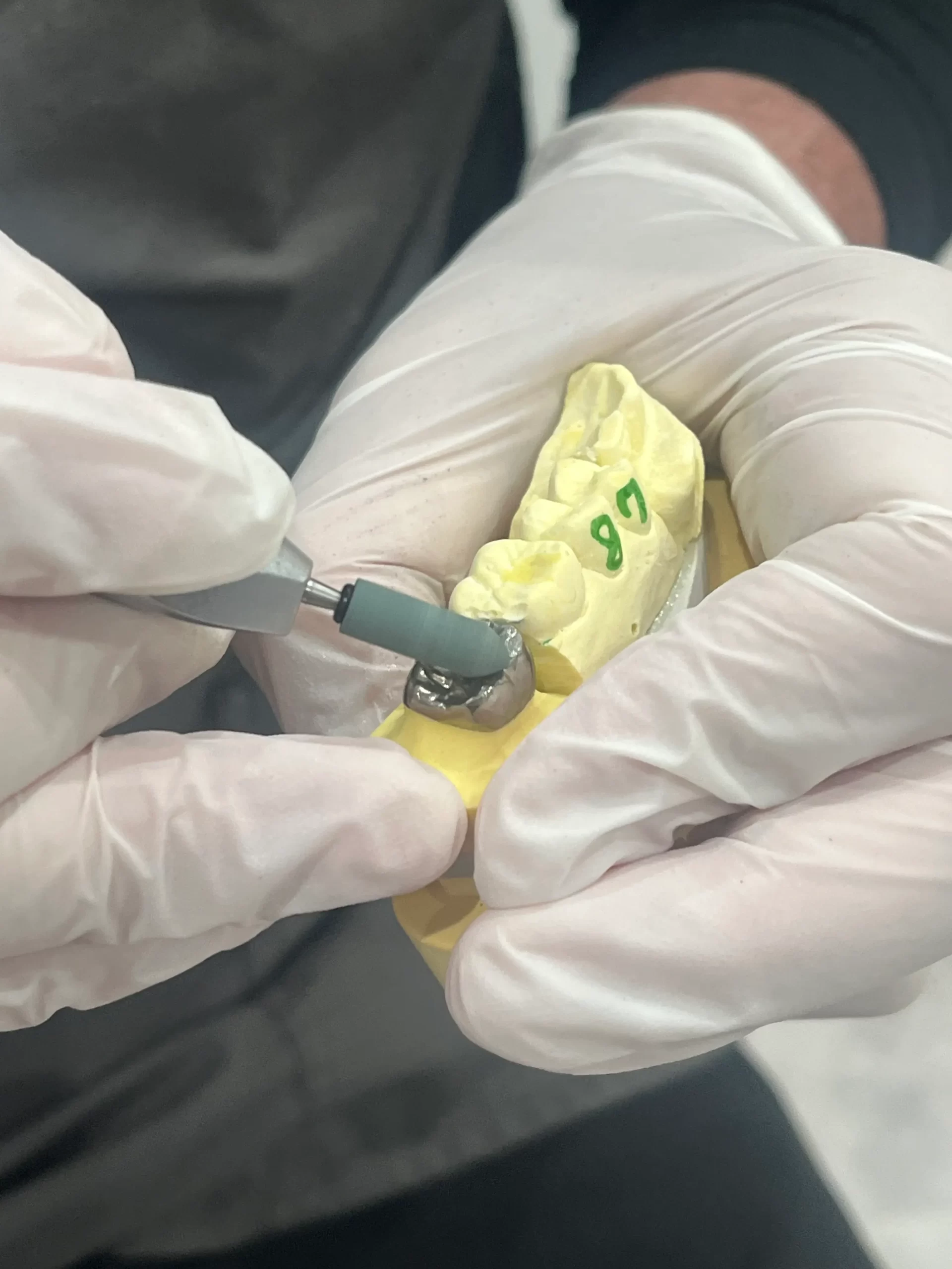 よくある質問　被せものが取れた　脱離