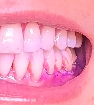 染め出し 磨き残し 歯科衛生士