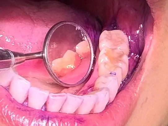 染め出し 定期検診 歯みがき指導